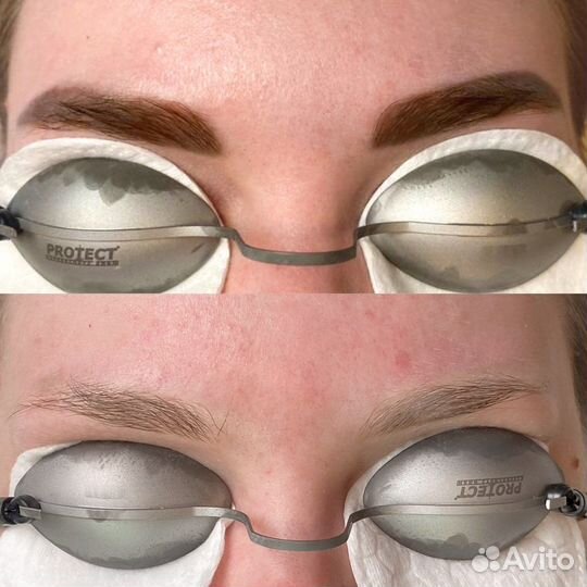 Удаление татуажа и тату