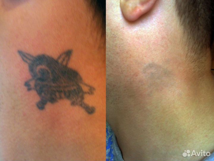 Лазерное удаление тату и татуажа