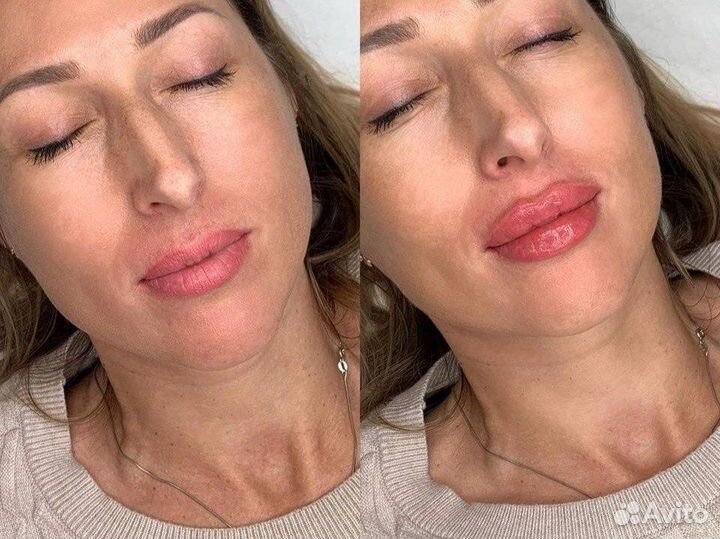 Мануальная мезотерапия