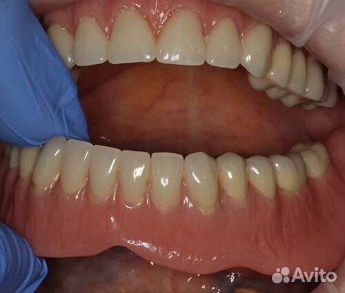 Несъёмный и Съёмный протез. нового или починка