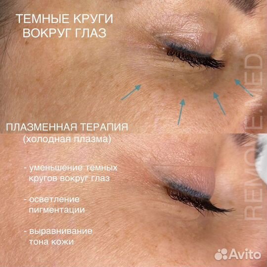 Холодная плазма процедуры обучение