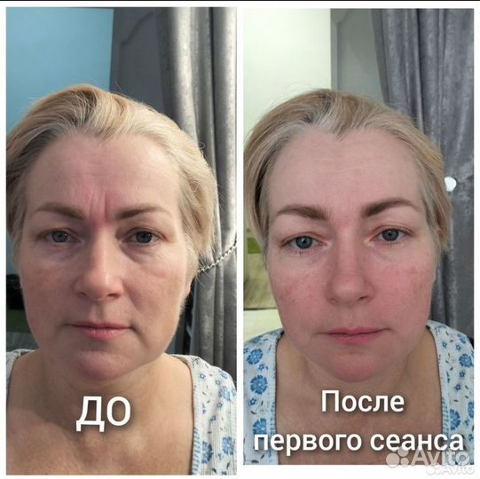 Модель на лимфомассаж лица