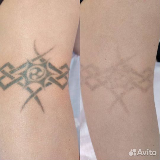 Лазерное удаление татуажа