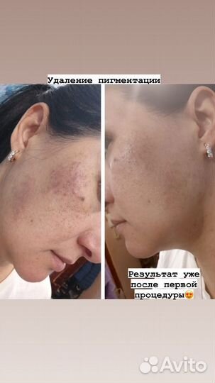 Массаж лица