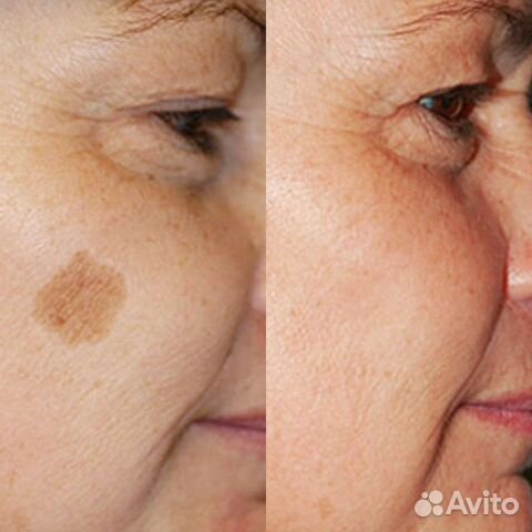 Удаление пигментных пятен, веснушек