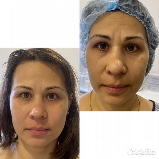 Скульптурно-буккальный массаж лица