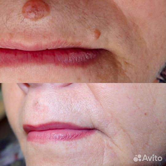 Удаление новообразований