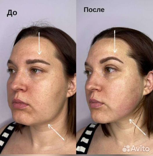 Smas лифтинг