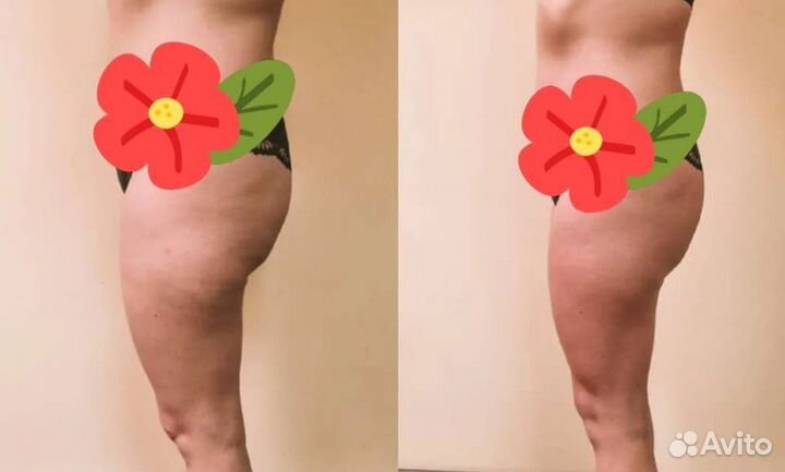 Массаж, кавитация, RF лифтинг, вакуум, вибромассаж