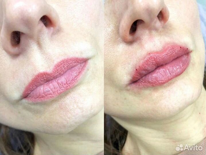 Биоревитализация