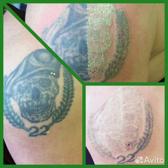 Удаление татуировок и перманентного макияжа