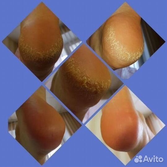 Педикюр Депиляция Лазер