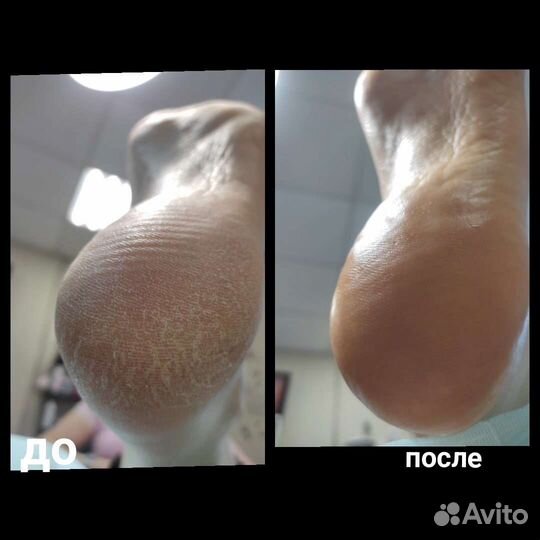 Педикюр