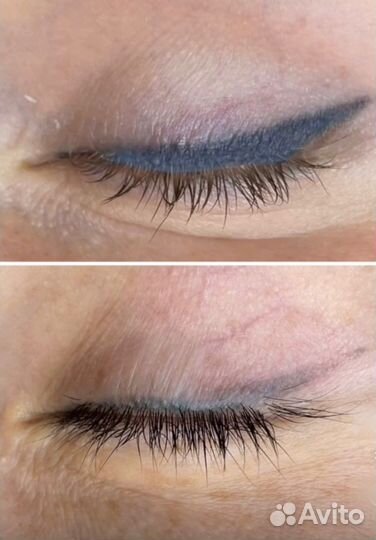 Удаление татуажа лазером