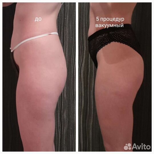Кавитация,rfвакуум,rfлифтинг, вибромассаж