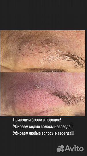 Электроэпиляция