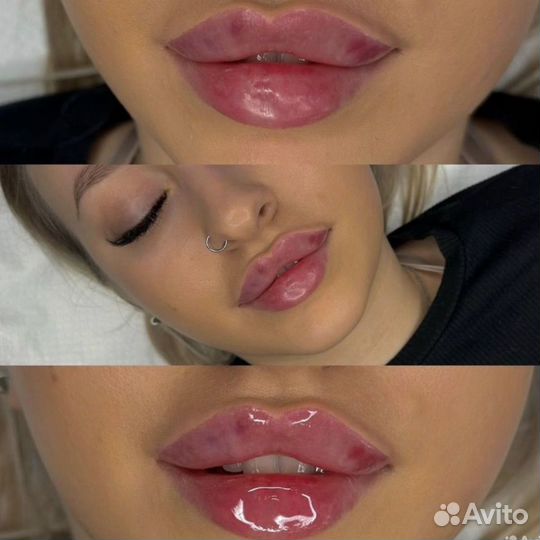 Модель на увеличение губ