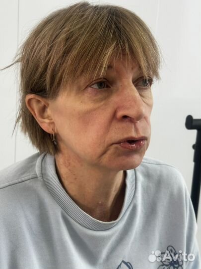 Мгновенный лифтинг лица, -10 лет за 1 процедуру