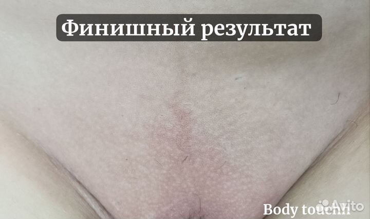 Электроэпиляция