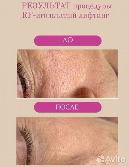 Rf игольчатый аппаратное омоложение в СПБ