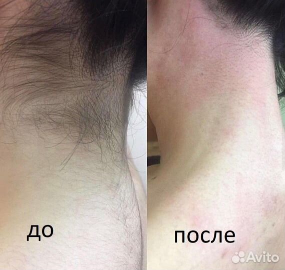 Лазерная эпиляция Элос