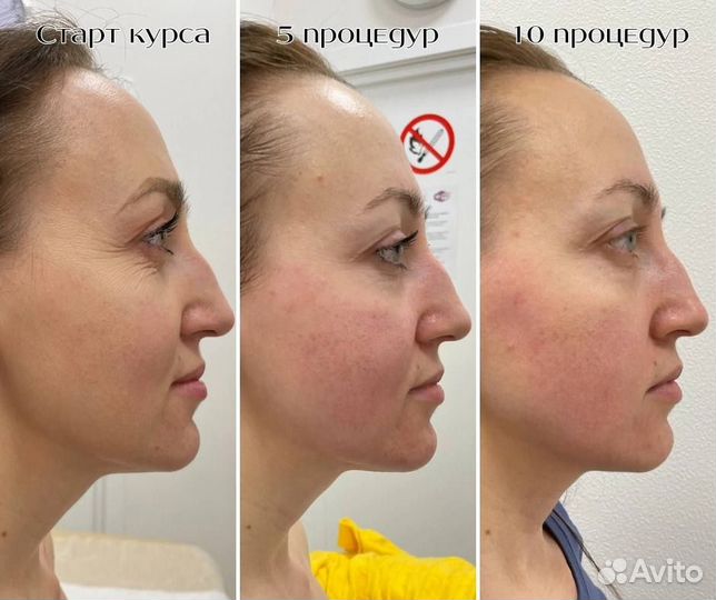 Скульптурный массаж лица