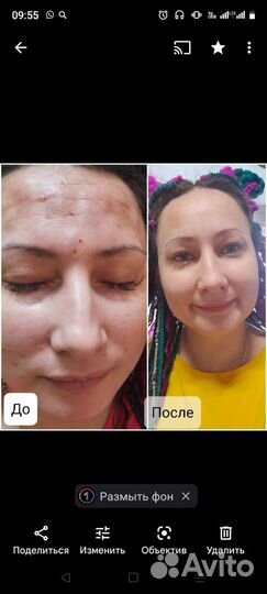 Плазмолифтинг