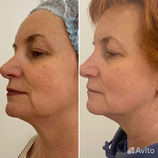 СМАС лифтинг