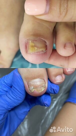 Модели на медицинский педикюр