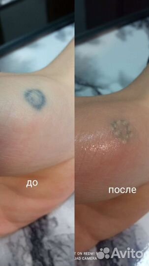 Лазерное удаление татуировок