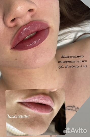 Увеличение губ/Косметолог/ ботокс