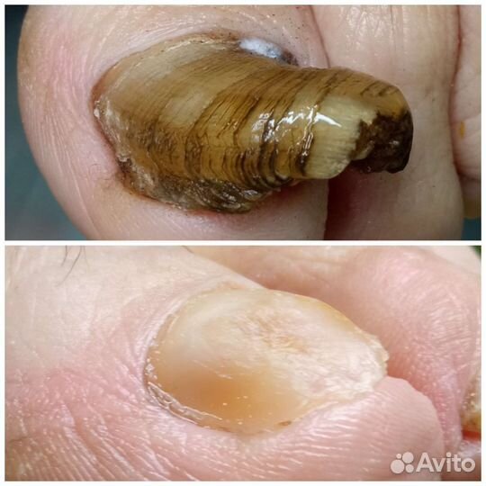 Медицинский педикюр/подолог