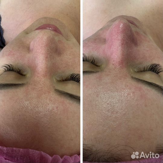 Комбинированная чистка лица, уходовые процедуры