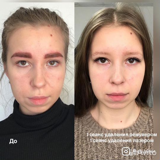 Удаление татуажа/тату