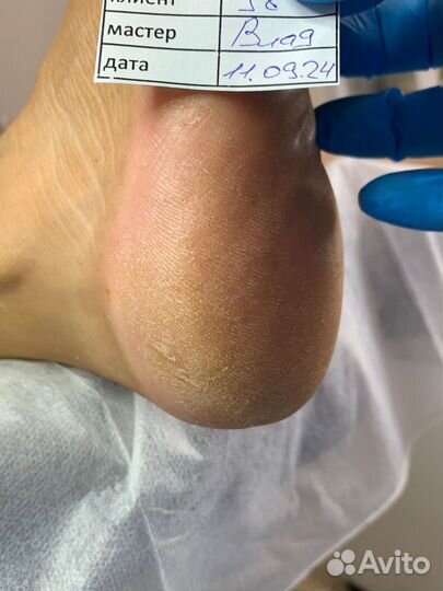 Подологический педикюр