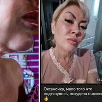 Безоперационная подтяжка лица Можайск, Можайск