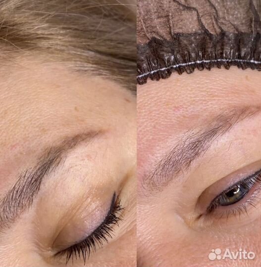 Удаление тату и ПМ ремувером