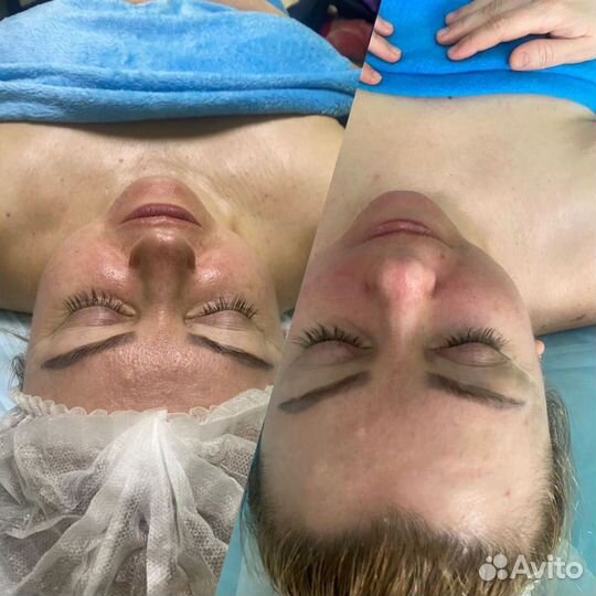 Массаж лица (три техники ) + Буккальный массаж