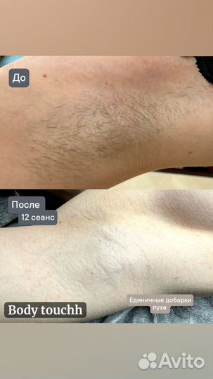 Электроэпиляция