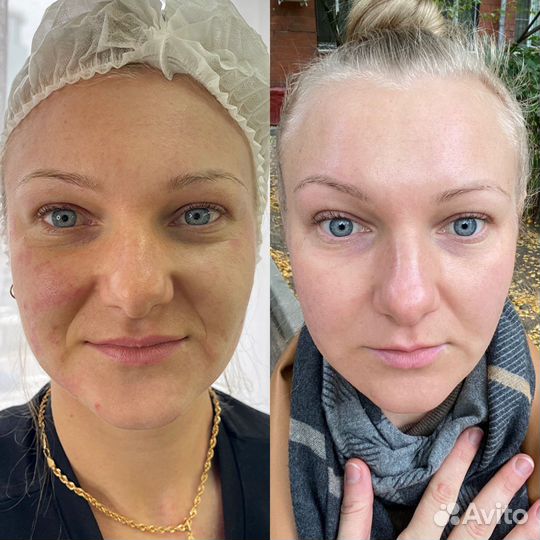 Услуги косметолога / Холодная плазма