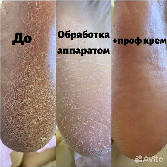 Подолог, педикюр