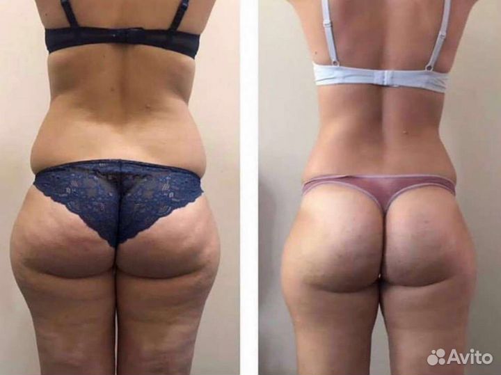 Аппаратный Массаж, Кавитация,Вакуум,Rf-лифтинг