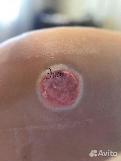 Пластырь от бородавок