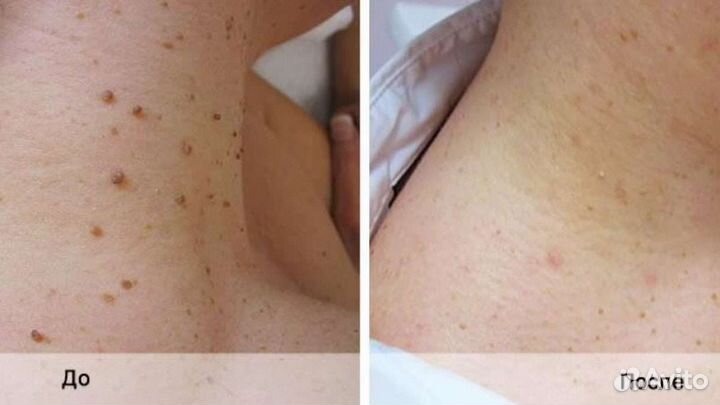 Удаление папиллом,родинок,бородавок