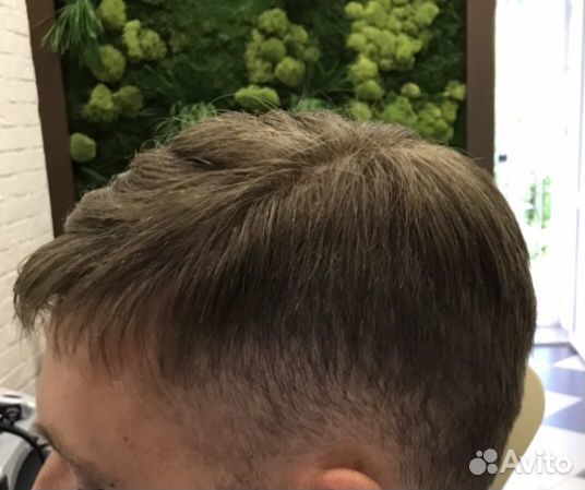 Мужская безоперационная система замещения волос