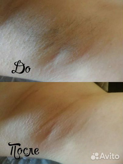 Шугаринг: подмышки