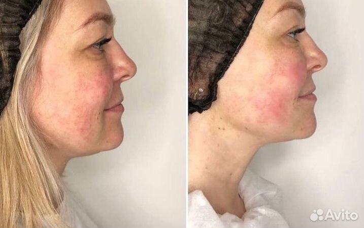 Смас лифтинг/микроигольчатый RF лифтинг