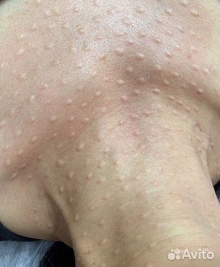 Биоревитализация