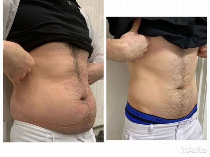 Криолиполиз, идеальная фигура без диет