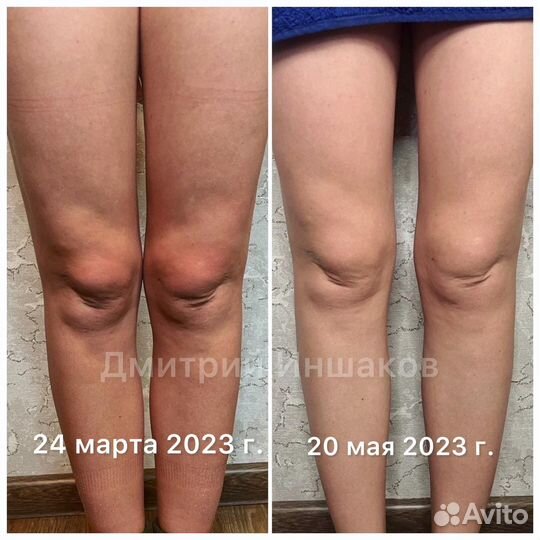 Армопластика Ручная липосакция Массаж